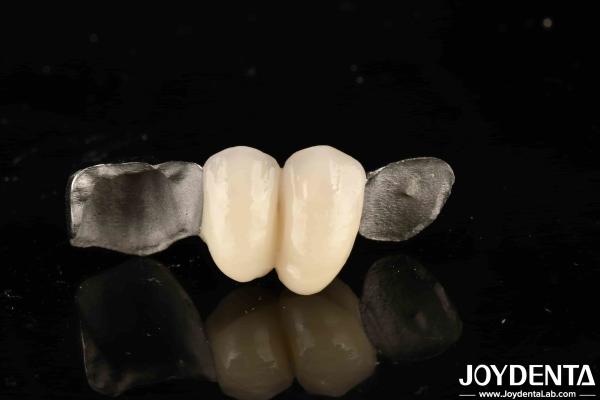 Metallic Dental Maryland Bonded Bridge Good Remediation For Oral Clinical Repair