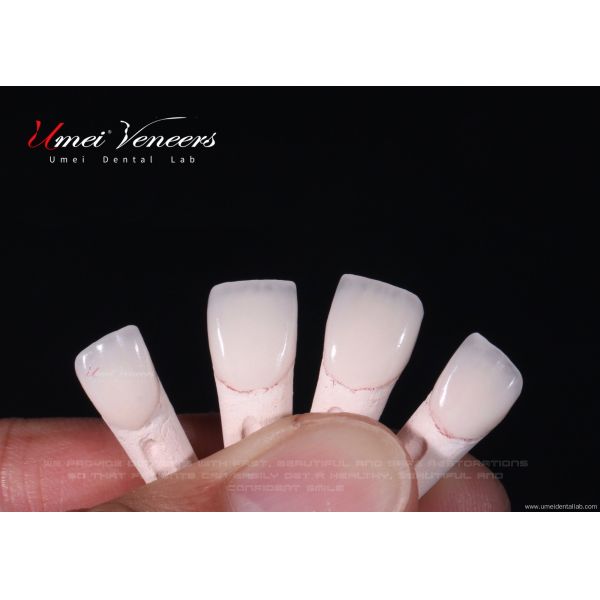 Ultra thin cast porcelain veneer