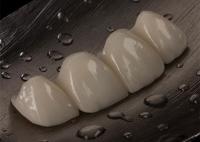 Ponte de coroa de cerâmica personalizável para dentes perdidos Confortável e perfeito