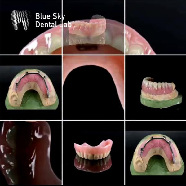 Acrylic Denture Dental Titanium Bar With Attachments Silver And Gold