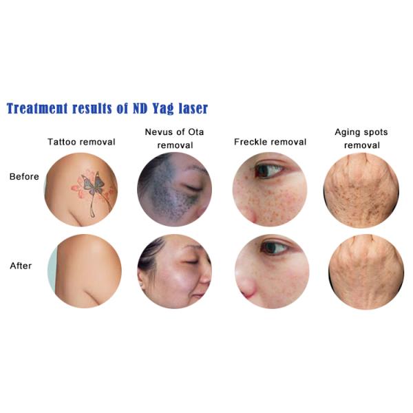 Машина для удаления татуировок Nd Yag Q Switched Laser Device