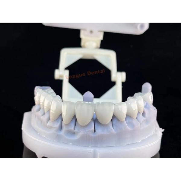 43%-46% Translucency PFZ Crown & Bridge Porcelain Fused To Zirconia Restorations