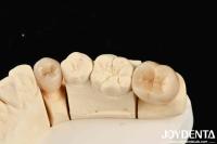 Excellente biocompatibilité: Zirconie complète avec une résistance élevée à la corrosion et une résistance à la flexion de 1000 MPa