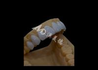 Prothèses dentaires Circonia Couronne dentaire Précise esthétique pour les dents à arc complet