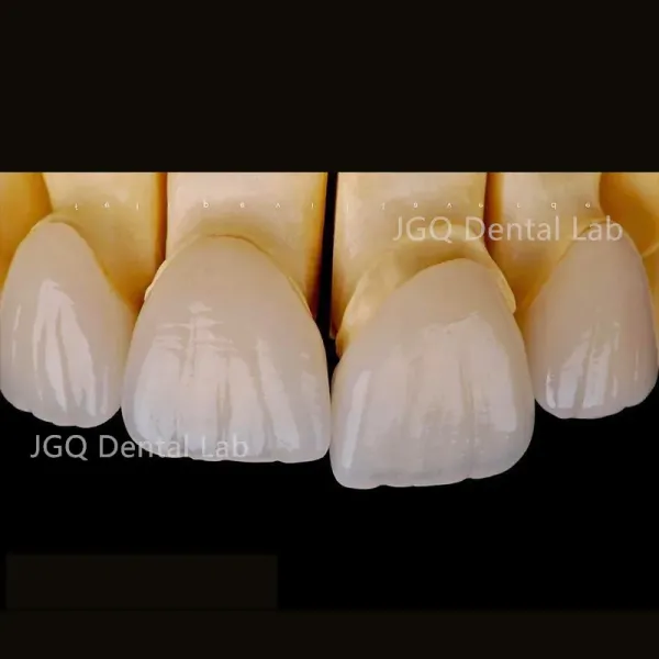 Zirconia Dentures Teeth Dental Lab Single Crown Anterior Posterior Dental Restoration