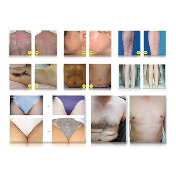 Multilingual 360 E - Light IPL Machine ND YAG OPT SHR Laser Hair Removal Device