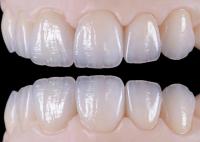 Ponte de coroa dentária de cerâmica natural resistente ao desgaste para restauração natural