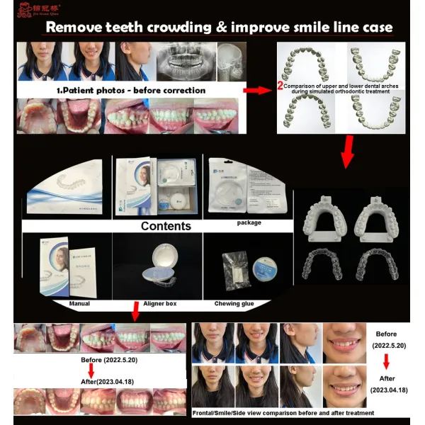 Personalized Customization Clear Aligners Precisely Fitting for Correct Teeth