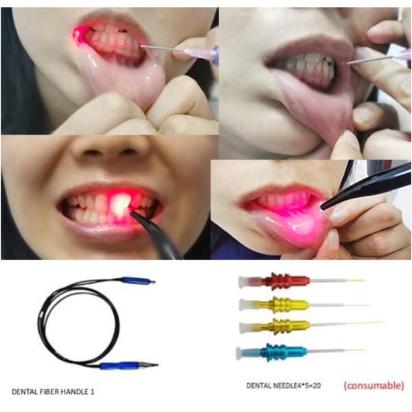 Laser de diodo de dientes de 650 nm a 980 nm en odontología para periodoncia endodoncia cirugía de tejidos blandos