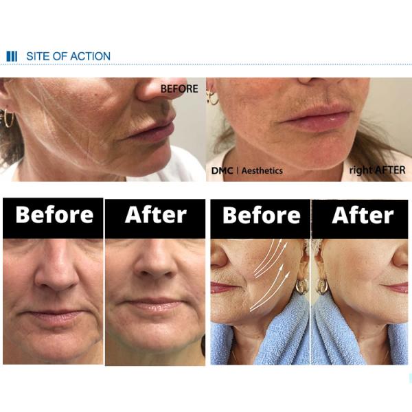 La elevación médica PDO PCL PLLA de la ceja rosca por último 18 meses