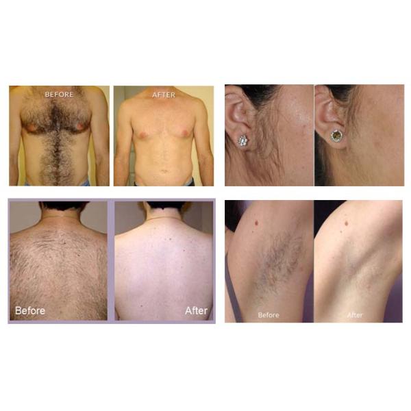 Permanent Diode Laser Hair Removal Machine , 808nm TUV Approved Laser Shaving Machine