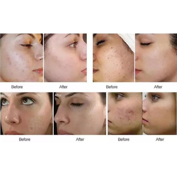 Meso решение 18AA+ Ha Mesotherapy уменьшает морщинки и стимулирует рост клетки