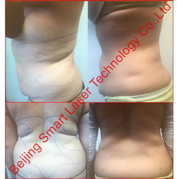 Vacuum Cryolipolysis Slimming Machine / Four Handles Coolsculpting Equipment