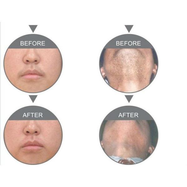 Multifunctional IPL Beauty Machine Hair Removal Acne Treatment Machine