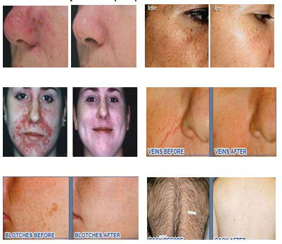 Light removal Lip Hair Beard Armpit diode laser 808 hair removal machine