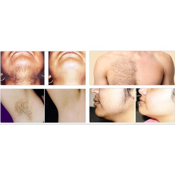 Portable 12 * 24mm Diode Laser Hair Removal Machine Semi Conductor Cooling