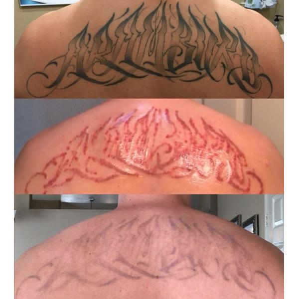 2 in 1 Laser Diode Machine Portable and Stationary Tattoo Removal 810nm 808nm Q-Switched ND Yag Diode Laser 810nm