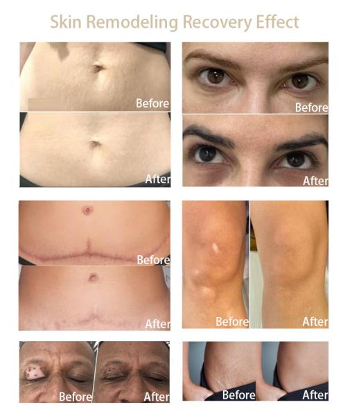 15ml Semi Permanent PMU Pigment Skin Remodeling Scars Remove White Freckles Vitiligo