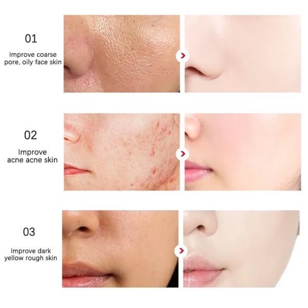 100ML Acne Exfoliating Toner With 2% Salicylic Acid Hydrating Facial Toner