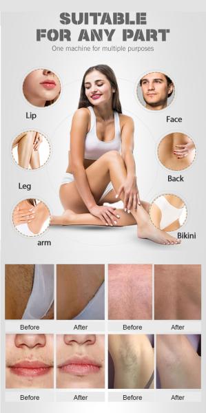 Remoção portátil Epilator do cabelo do laser 755 808 1064nm do dispositivo indolor do laser do diodo de YAG IPL