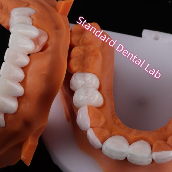 Литий Дициликатный слой Ivoclar Emax Zirconia Ламинированные фанеры Прозрачные OEM ODM