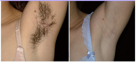 4 в 1 машине лазера Nd Yag, машина удаления волос лазера диода Elight IPL