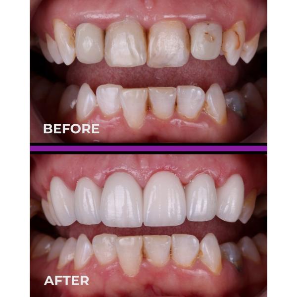 Диск блока PMMA фрезерования кулачков зубоврачебный PMMA CAD для зубоврачебного Laborotory