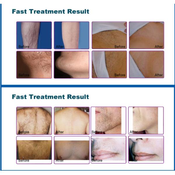 110V 220V Diode Laser Hair Removal Beauty Machine 808nm Painless For Permanent