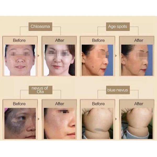 Professional Nd Yag Laser Tattoo Removal Machine Stationary Type For Hospital