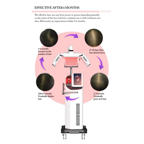 Machine de croissance des cheveux à diode laser de 660 nm, machine de traitement de la perte de cheveux.