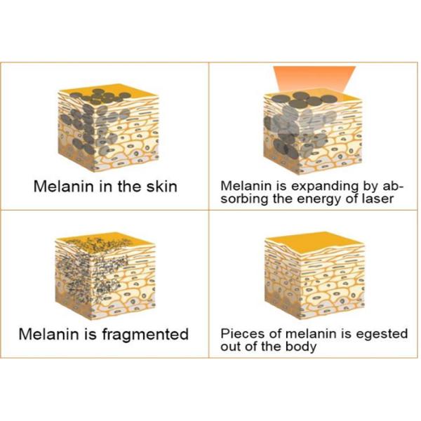 Easy Operation Picosure Laser Machine Freckles Scar Removal Tattoo Pigment