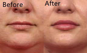 Заполнитель увеличения 5ml Derm впрыски губы дермальный для сыворотки заботы кожи носа Chin