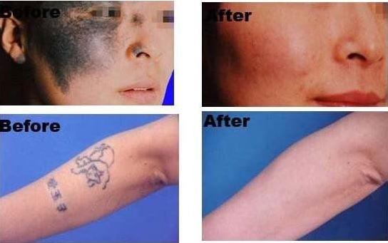 E-luz vertical 3Handles TruMED de la máquina 3500W del retiro del pelo del IPL (SHR+IPL+Nd: Yag)