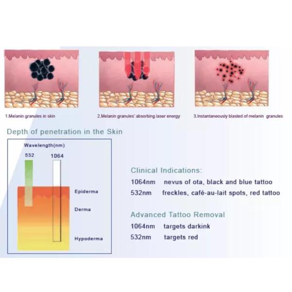 Professional Nd Yag Laser Tattoo Removal Machine Stationary Type For Hospital