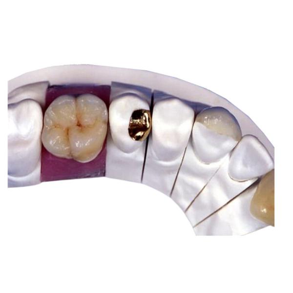 PFM Porcelain Dental Crown