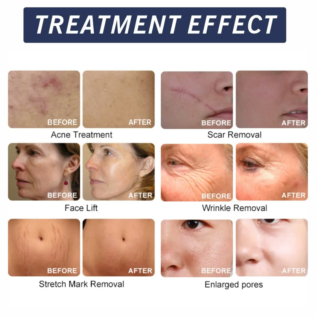 2 In 1 RF Microneedling Machine For Skin Tightening / Acne Scar Treatment Clinics