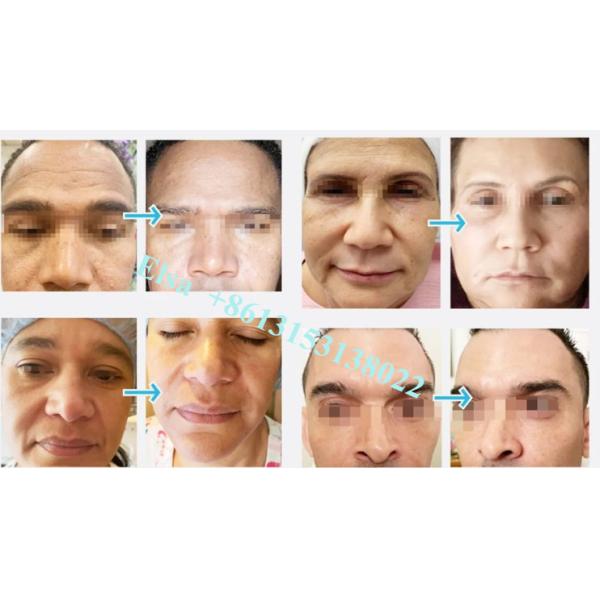 Hyaluronic Acid Gel Injection Juvederm Lip Filler Ce Anti Aging 1ml 2ml 5ml