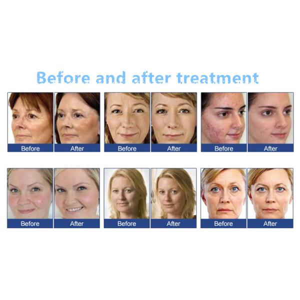 Портативный забеливать кожи клиники машины двигателя кислорода заботы кожи