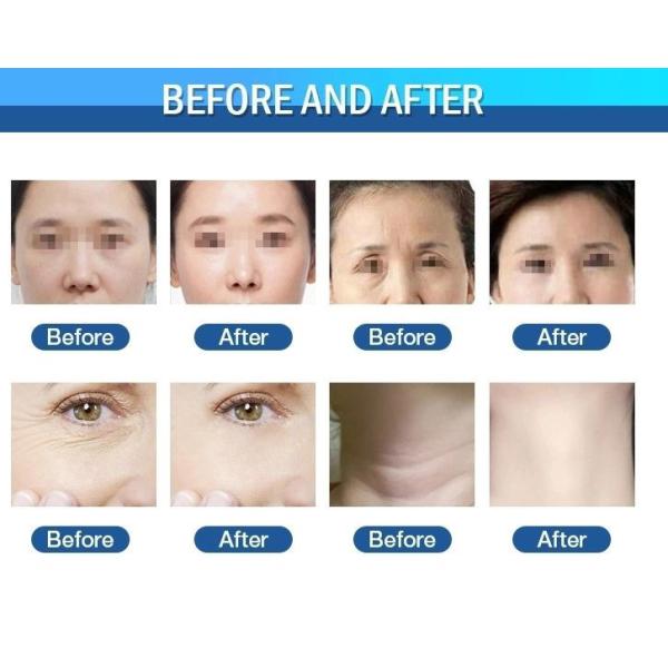 Vmax Ultrasound HIFU Lifting Machine 60000 Shots 4 Cartridges Anti Aging