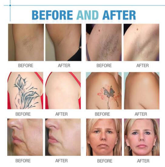 Factory china cheap home use professional intense pulsed light ipl photofacial permanent hair removal machines price