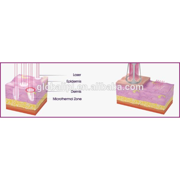 Portable Fractional CO2 Laser Machine for Skin Rejuvenation  Scar Removal and Vaginal Therapy