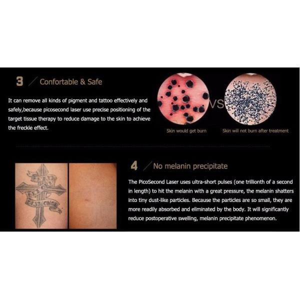 Korea Arm 532nm 1064nm 755nm Picosecond Laser Tattoo Removal Cholsma Removal