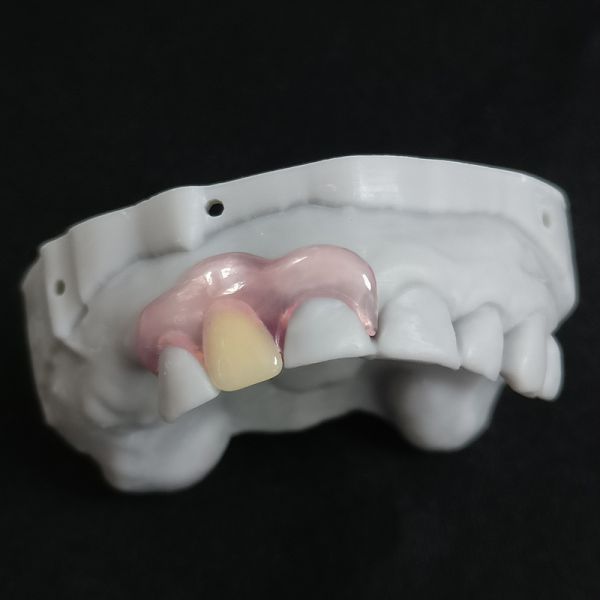 Acrylic Removable Valplast Denture Durable for Restorative Dentistry