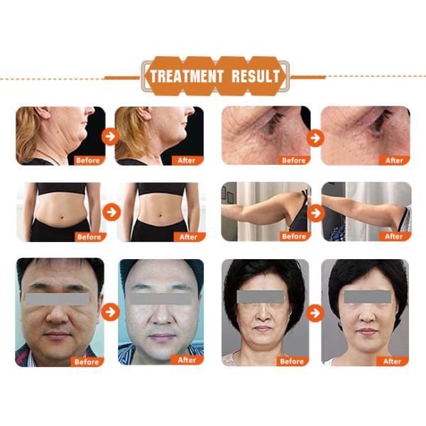 уменьшение красоты Hifu ультразвука тела машины Hifu подтяжки лица 3d 4d 7d