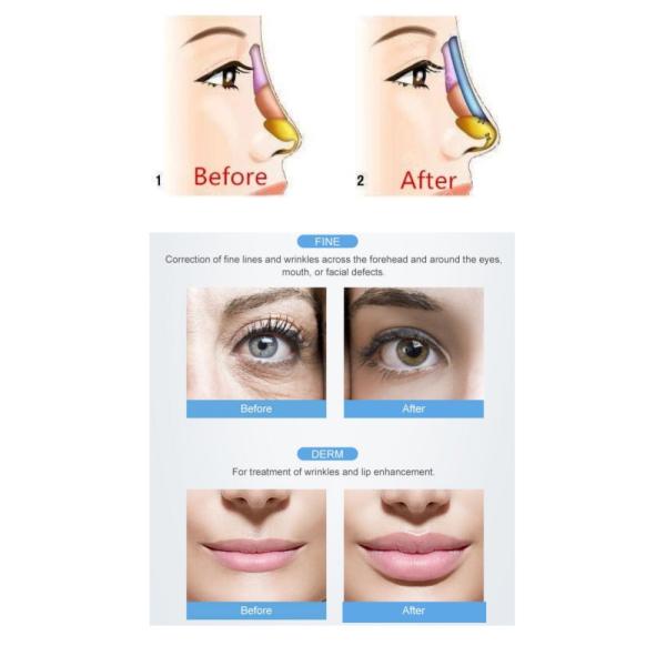 Creme hidratante ácido hialurónico 20mg/Ml coreano de Rejeunesse do enchimento profundo fino da forma