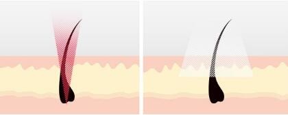 Skin Lifting Shr Laser Machine Permanent Hair Removal Machine Acne Treatment