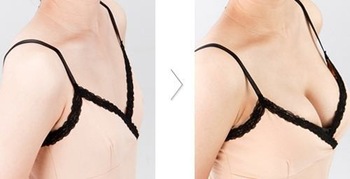 Заполнитель груди Хялуроник кислоты личной заботы 10мл для увеличения размера груди