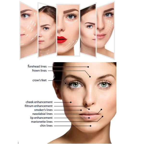 levage émoussé coréen de Pdo de canule ultra V de fil de 4d 100mm PDO de l'ascenseur