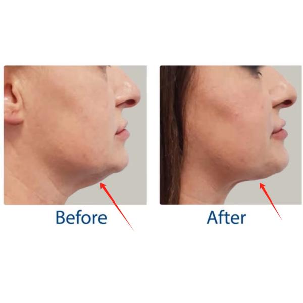 Coolwaves Cryotherapy Cool Radio Frequency Ems Muscle Stimulation Body Contouring Machine