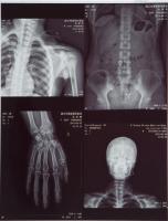 High-clarity Medical X Ray Film FUJI DIHT 14*17in Laser Dry Imaging Film